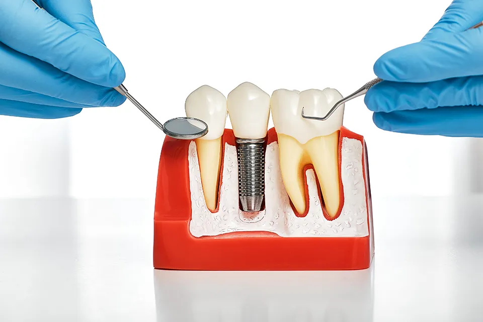 Affordable Dental Implant in Summerhill, Toronto