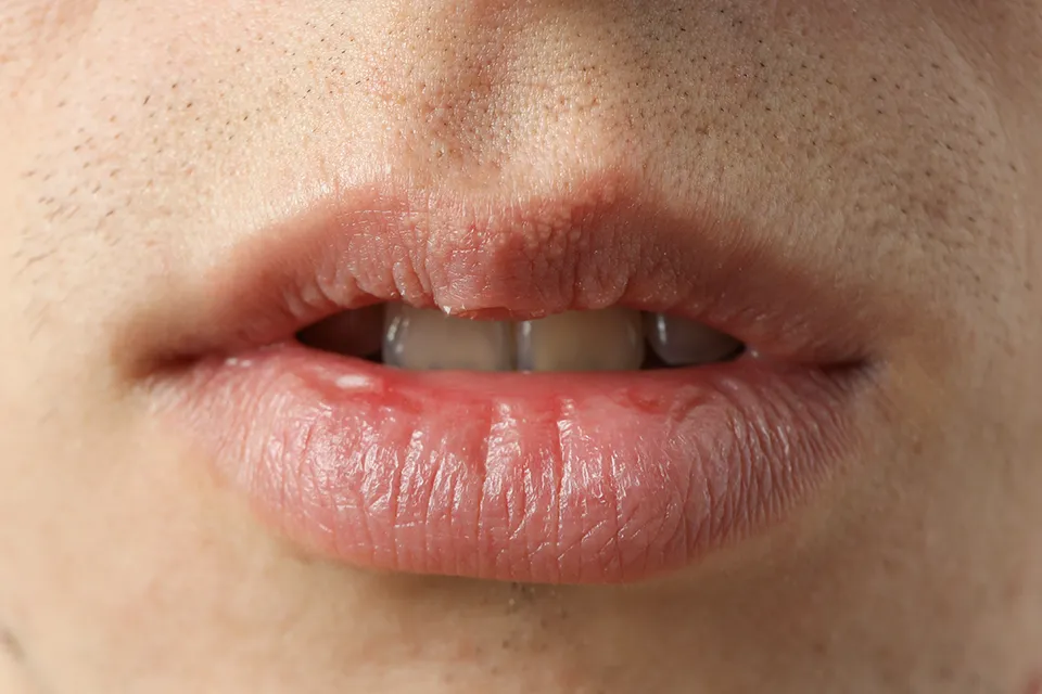 Dry Mouth Treatments