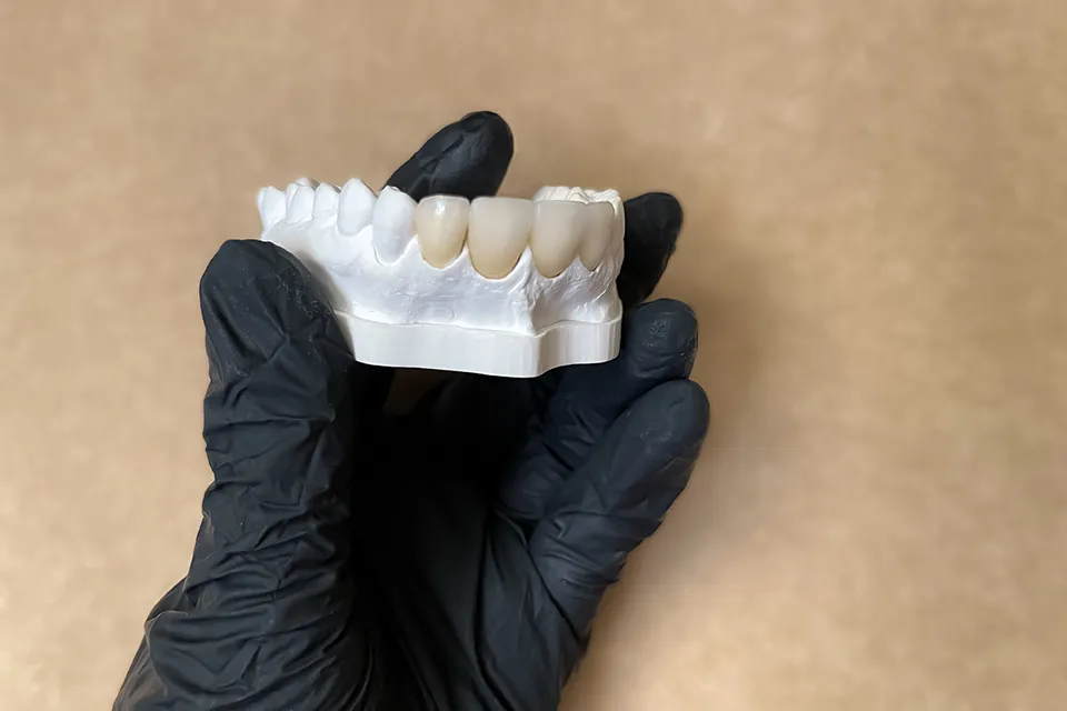 Affordable Dental Bridges in Summerhill, Ontario