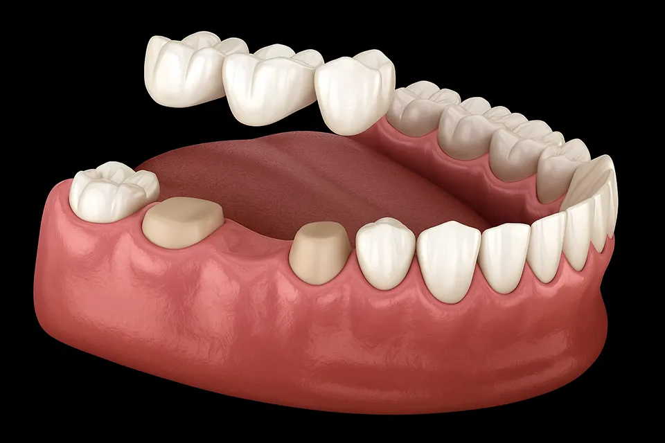 Cost of Dental Bridges