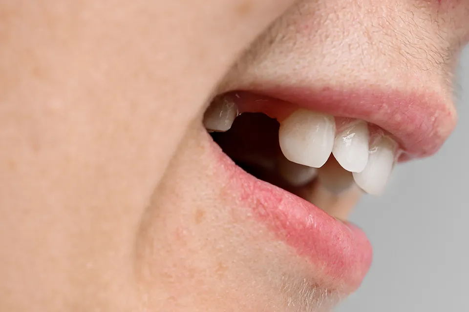 Managing a Normal Socket After Tooth Extraction