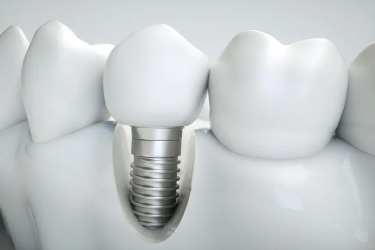 Recovery Time for Dental Implants