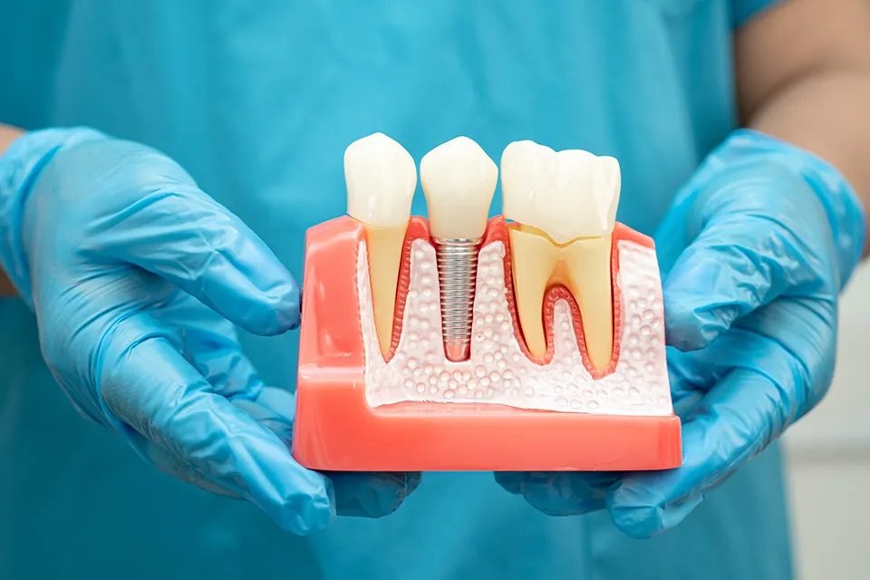 Recovery Time for Dental Implants