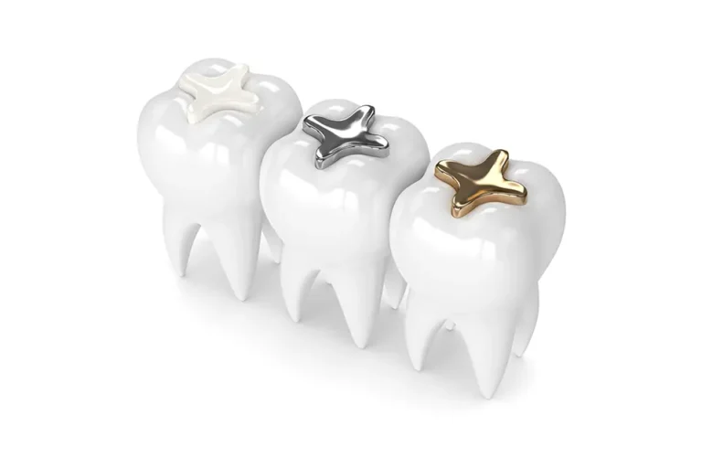 The Best Material for Dental Fillings