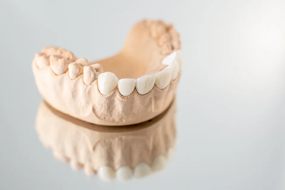 Dental Bridges Vs Implants