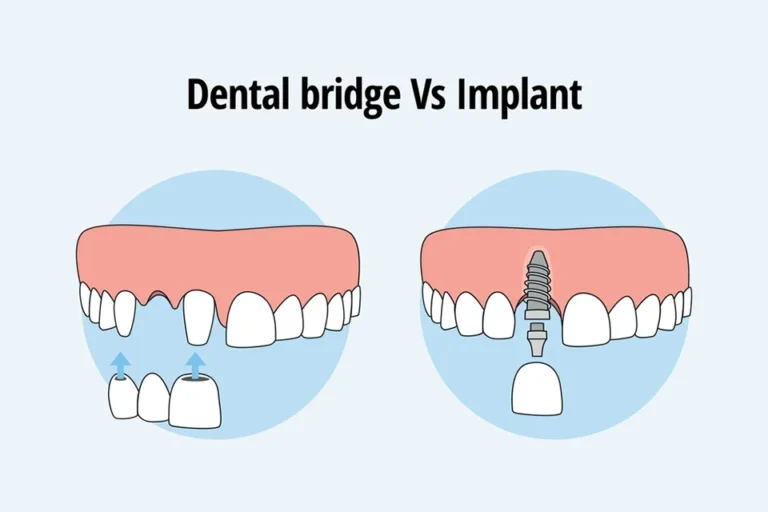 Dental Bridges Vs Implants