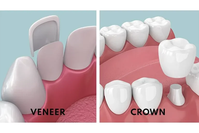 The Main Difference Between Veneers and Crowns