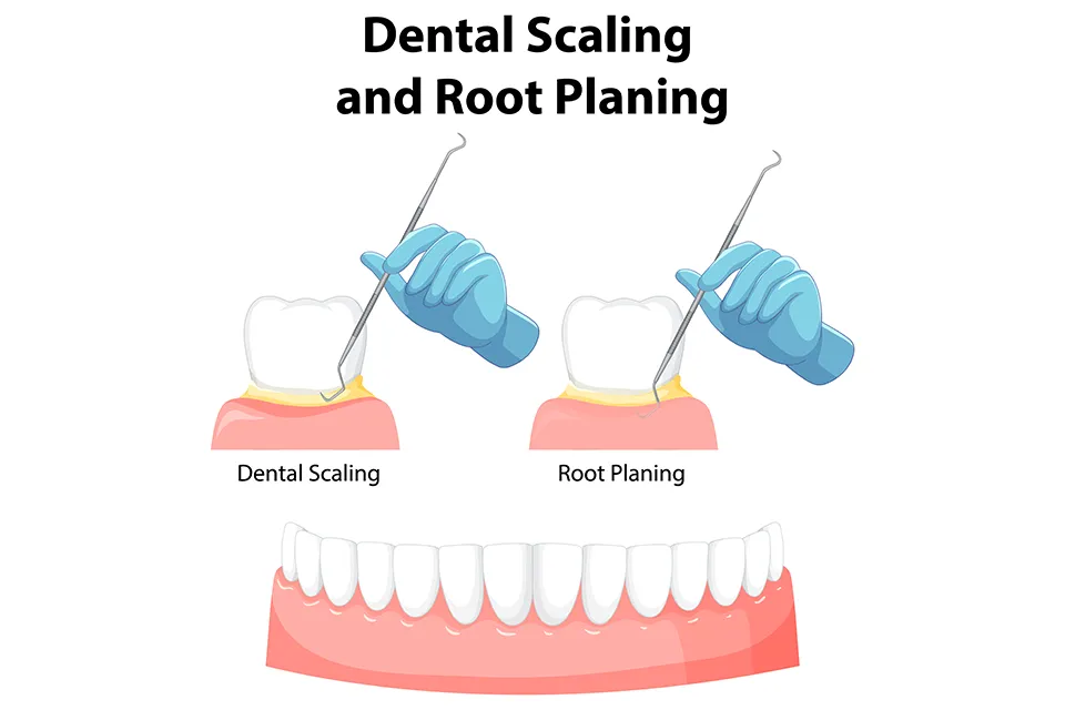 Scaling and Planing Care: Everything You Need to Know
