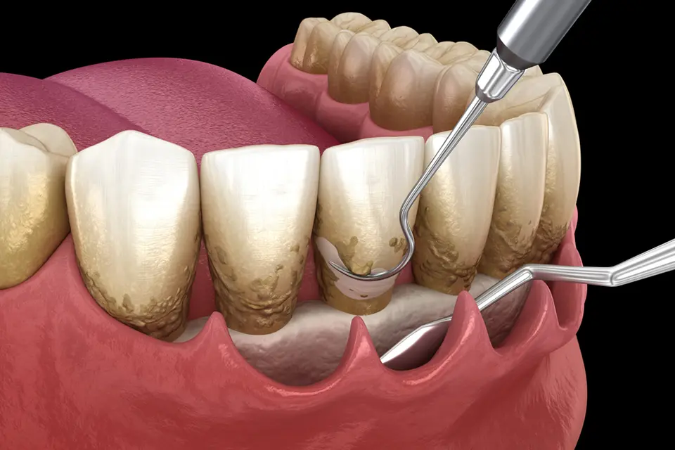 Understanding Root Planing for Gum Disease