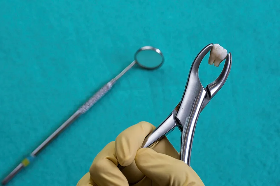 What is the Recovery Time for Wisdom Teeth Removal?