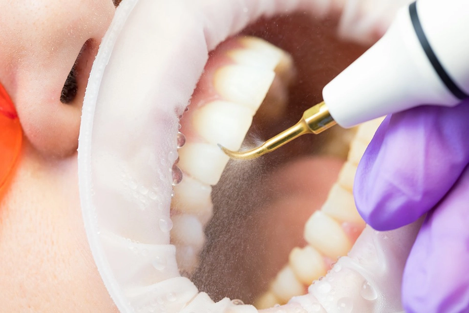 Plaque Removal: Essential Guide for Healthy Smiles