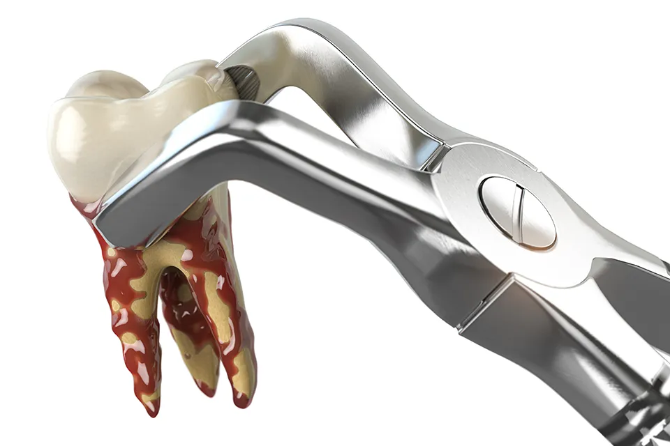 Tooth Extraction Complications