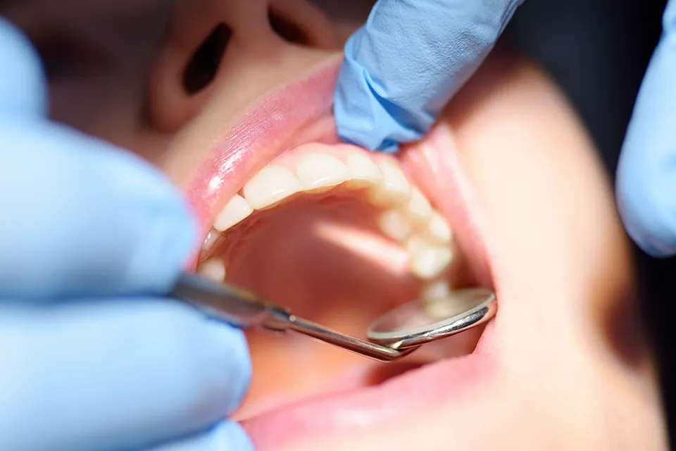 Preventing Tooth Decay in Children: A Guide for Parents