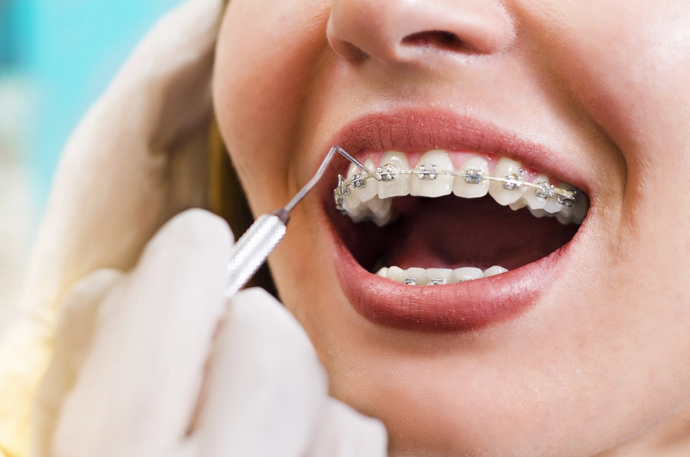 Benefits of Early Orthodontic Treatment