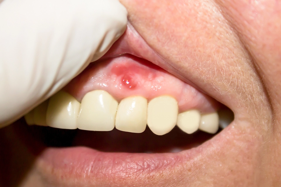 Preventing Gum Infections: Your Guide to a Healthy Smile