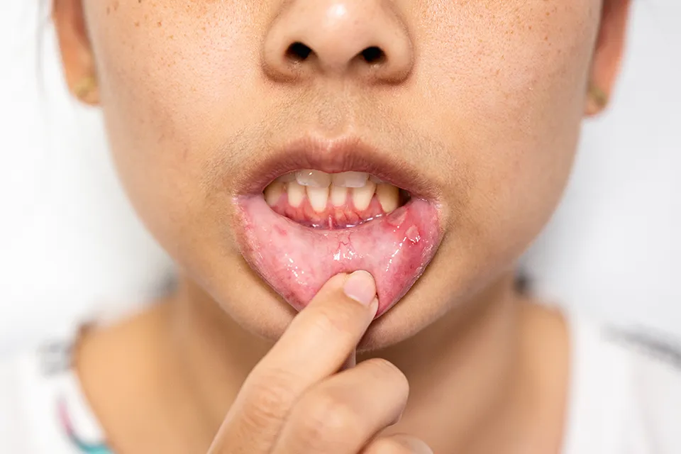 Preventing Gum Infections: Your Guide to a Healthy Smile