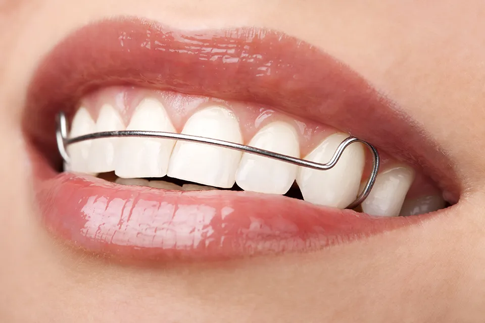 Retainers After Orthodontic Braces: A Comprehensive Guide