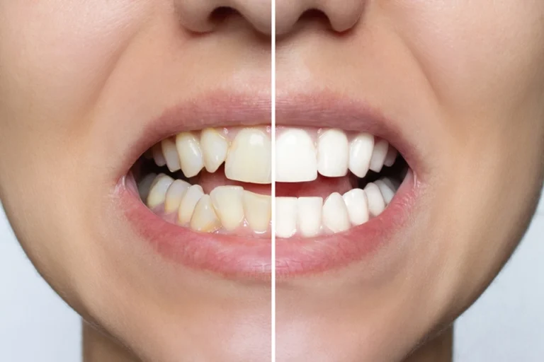 Dental Veneers for Crooked Teeth