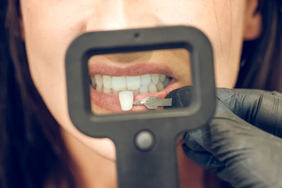 Dental Veneers for Crooked Teeth