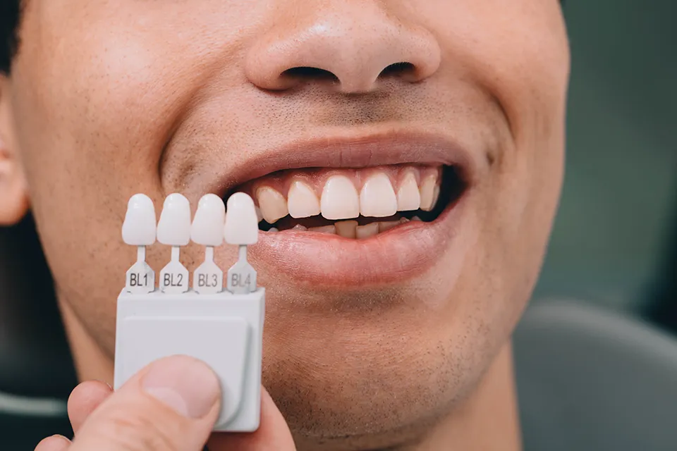 Dental Veneers vs. Teeth Whitening