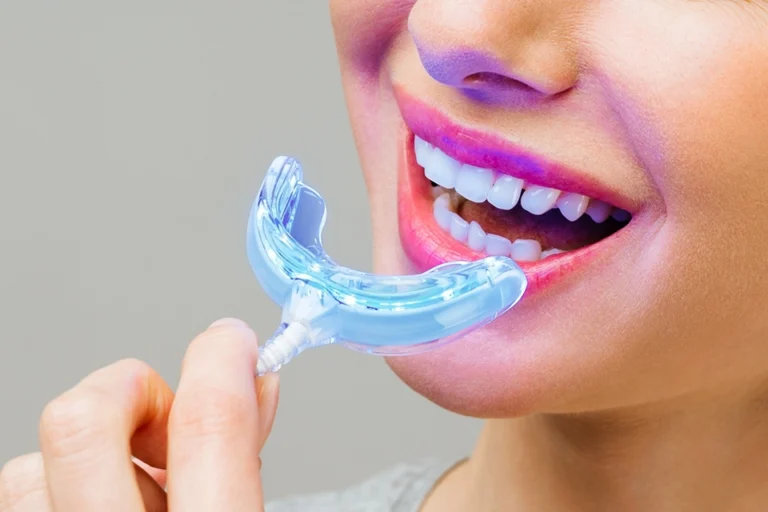 Why Consider Teeth Whitening at Home?