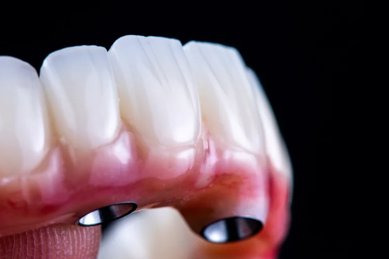 Types of Dental Bridges: A Comprehensive Guide