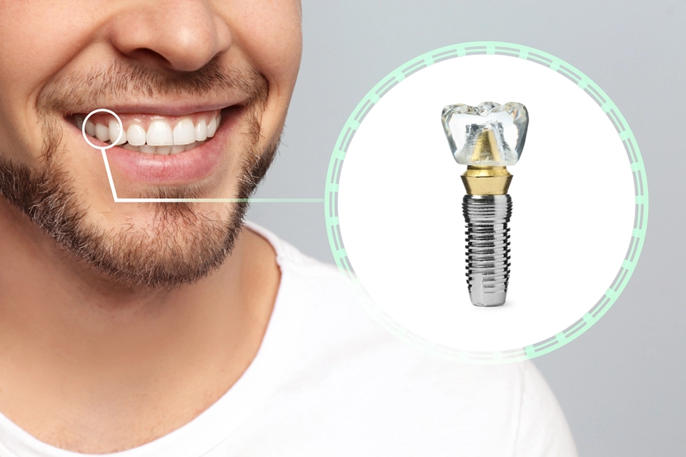 Types of Dental Implants