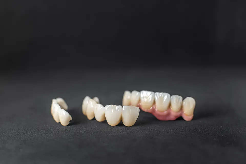 What Are Temporary Dental Bridges?