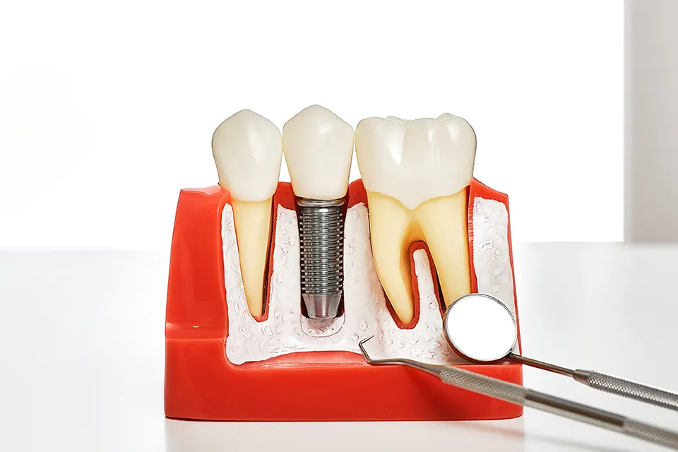 Types of Dental Implants