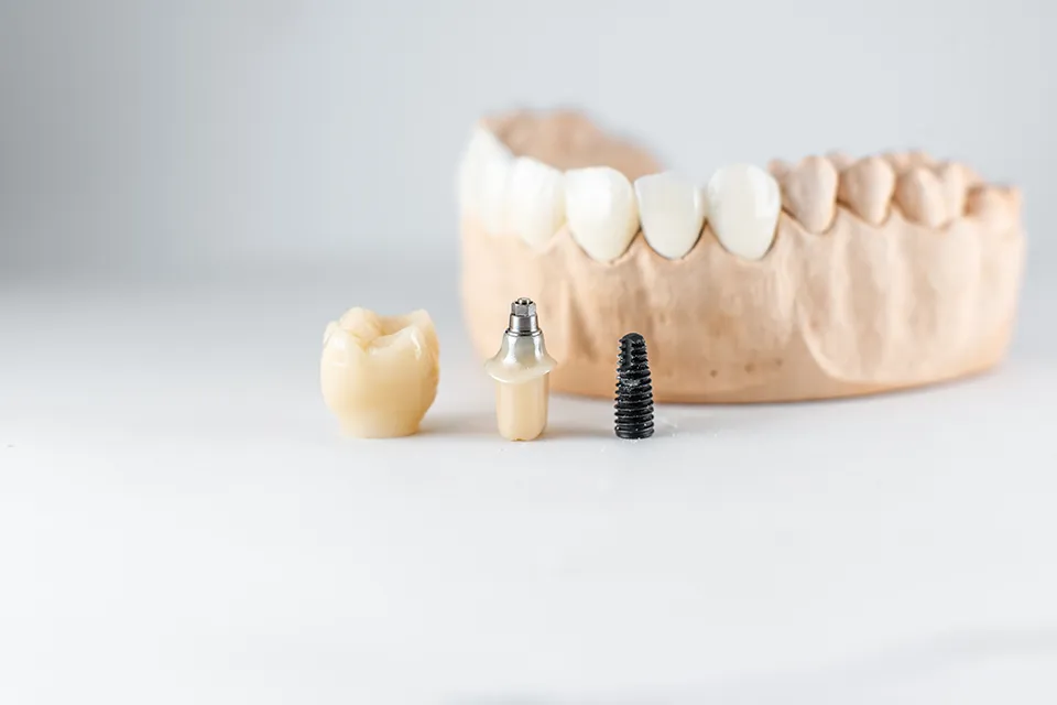 Understanding the Risks of Dental Implants