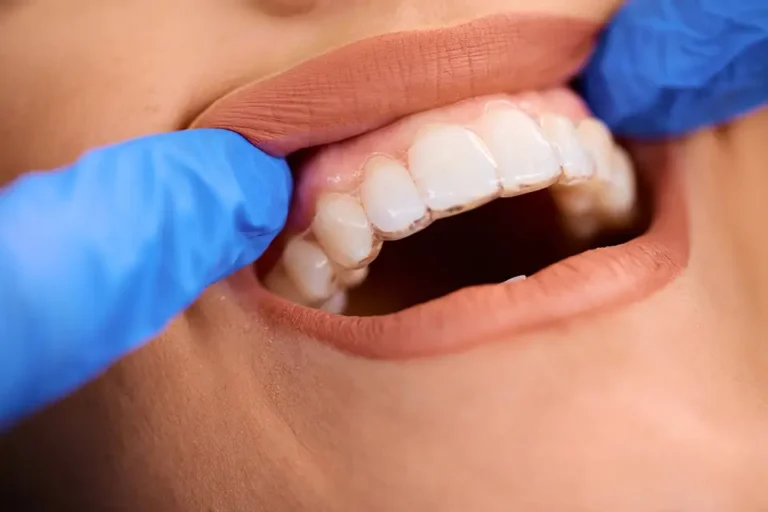 Invisible Braces: A Modern Solution for a Perfect Smile