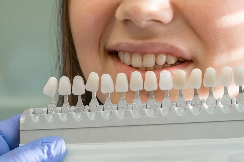 Lifestyle Habits and How to Take Care of Porcelain Veneers for the Long Term
