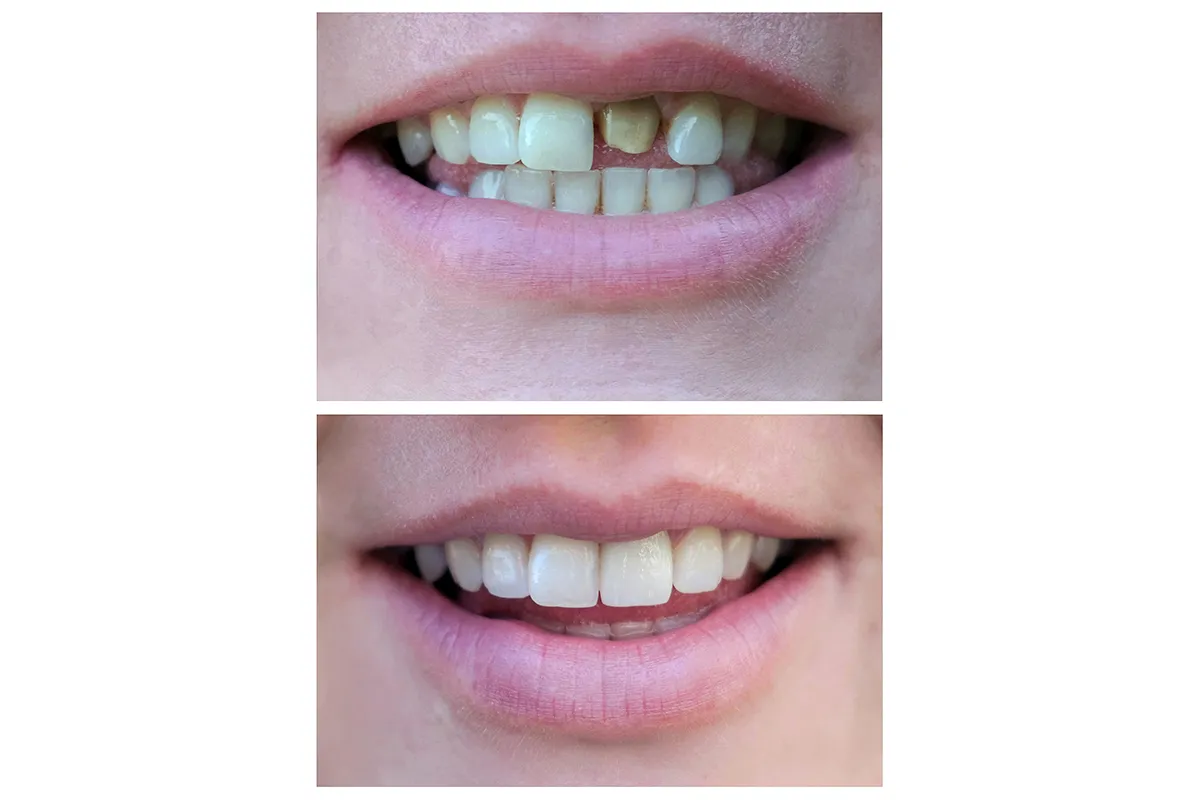 Dental Crowns