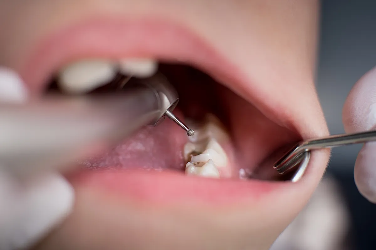 Dental Fillings