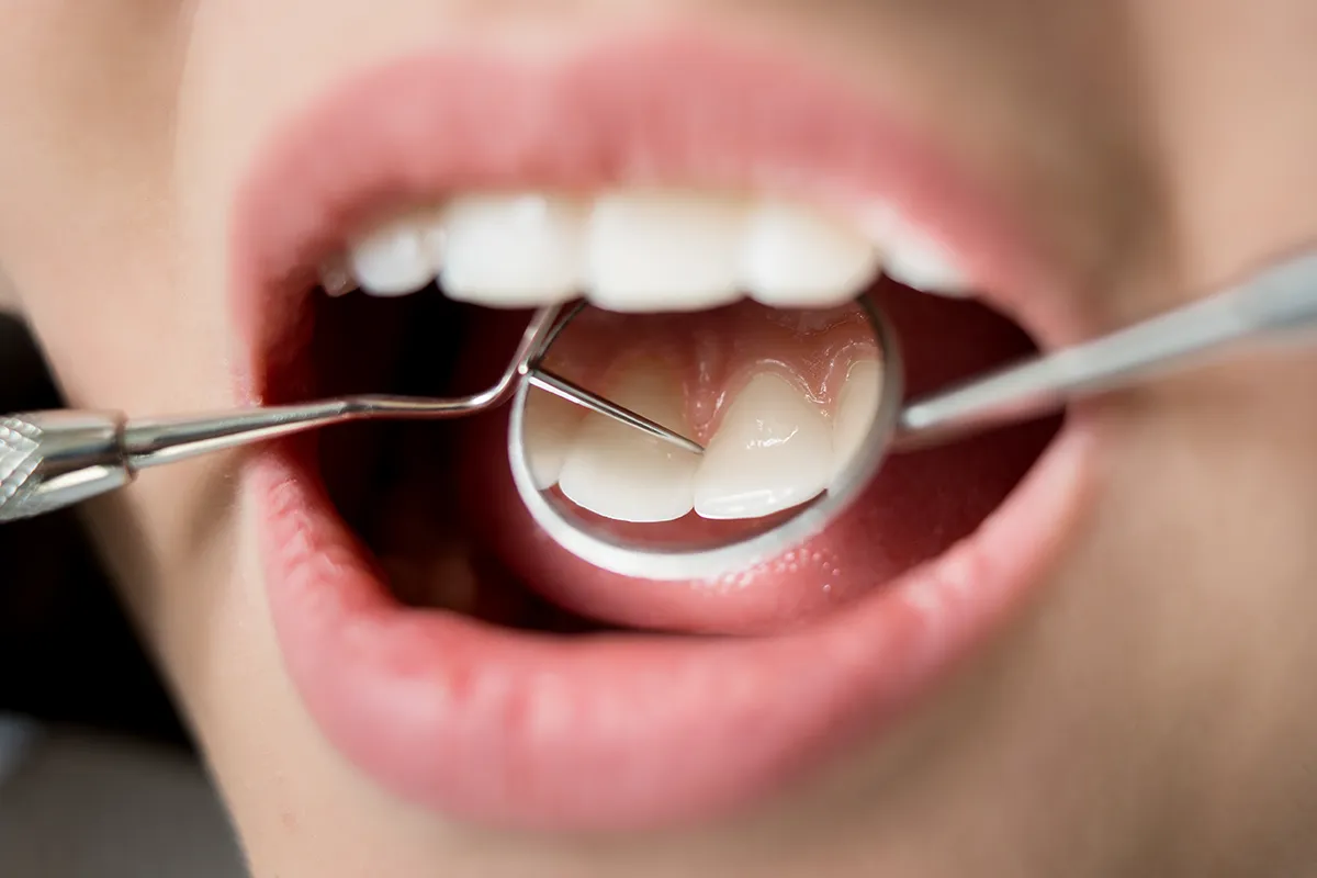 Oral Hygiene