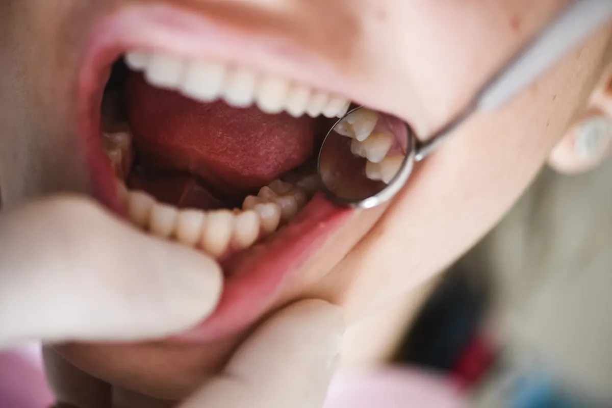 Tooth Extractions
