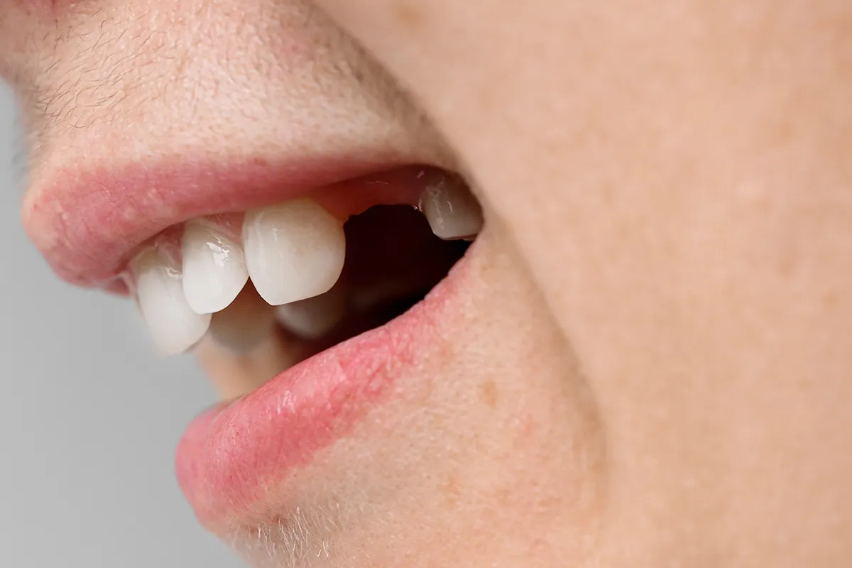Tooth Extractions