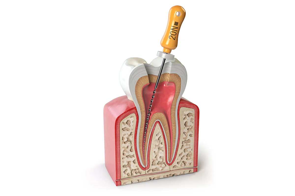 Gentle Root Canal Treatment in Toronto