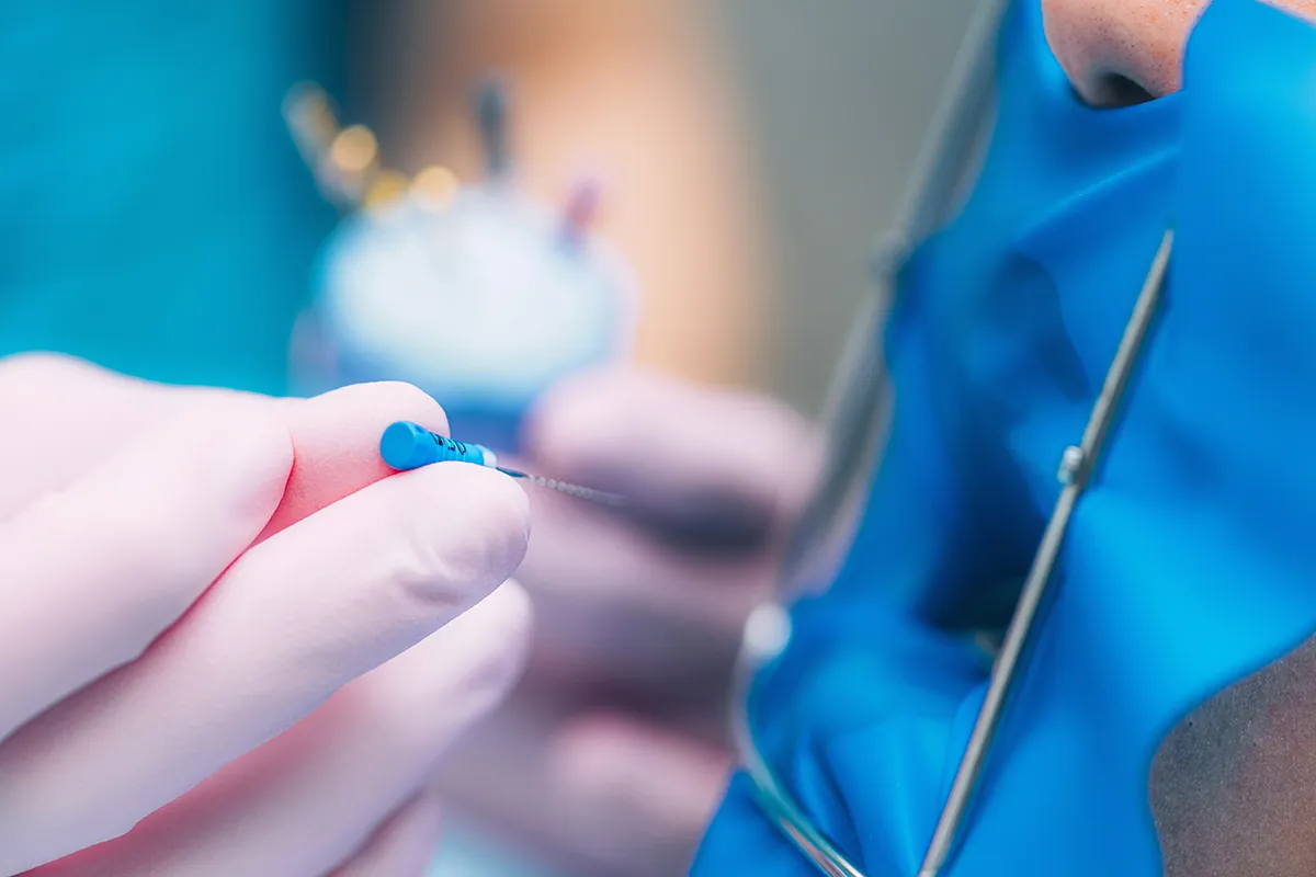 Gentle Root Canal Treatment in Toronto