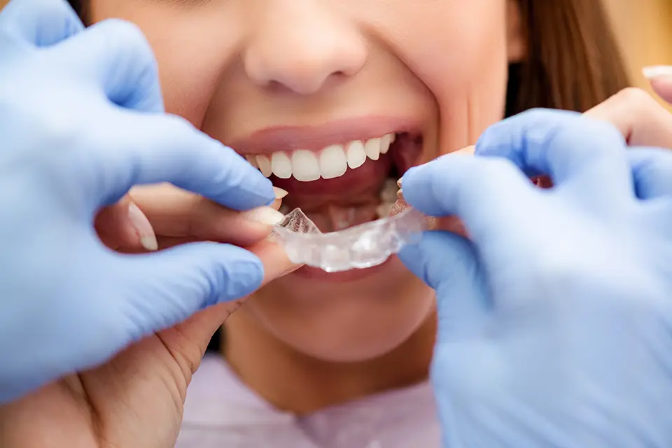 Downtown Toronto Invisalign Dentist: Your Guide to Clear, Confident Alignment