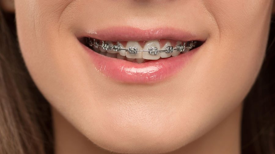 A woman with braces smiling, showcasing the positive impact of orthodontics on her dental alignment and overall appearance