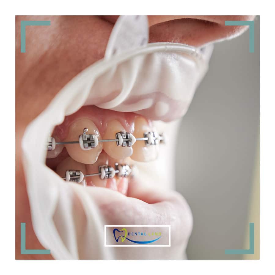 A person with braces on their teeth, undergoing orthodontic treatment for dental alignment