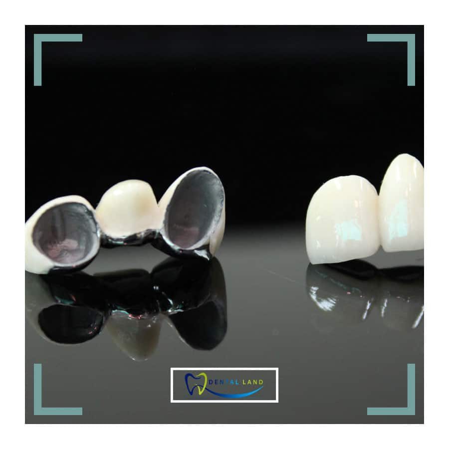 porcelain-fused-to-metal dental crowns