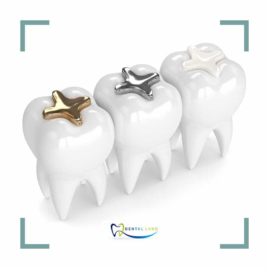 Three teeth with gold, silver, and composite fillings