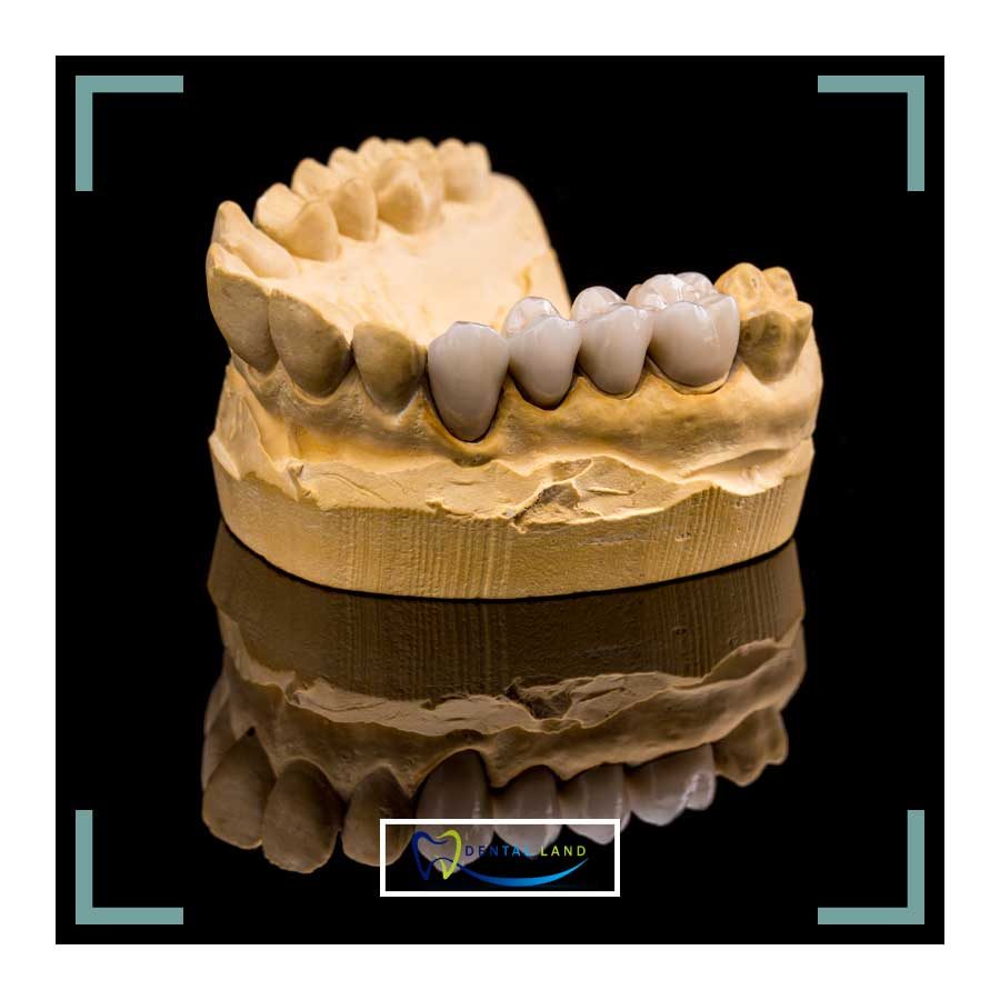 A pressed ceramic dental crown model showcasing a tooth within it