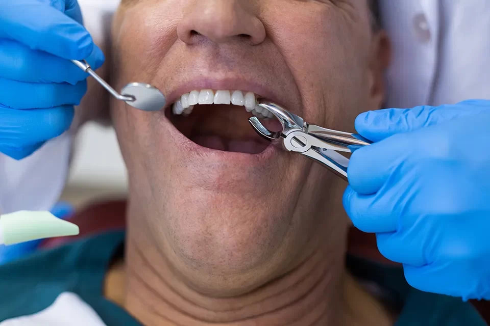 Tooth Extraction When Are Alternative Treatments to Root Canals Appropriate?