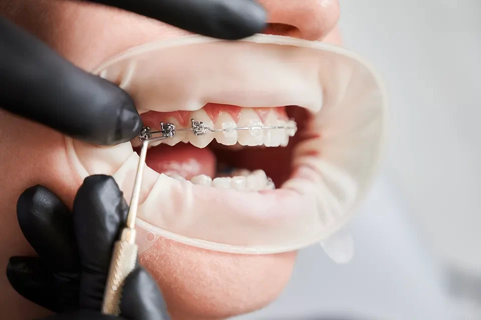 What is Early Orthodontic Treatment?