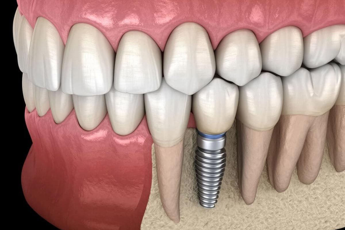 Seven Benefits of Dental Implants