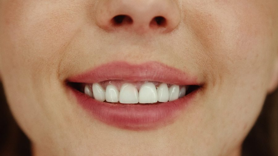 A close-up of a woman's radiant smile, showcasing her white teeth after undergoing scaling and root planing