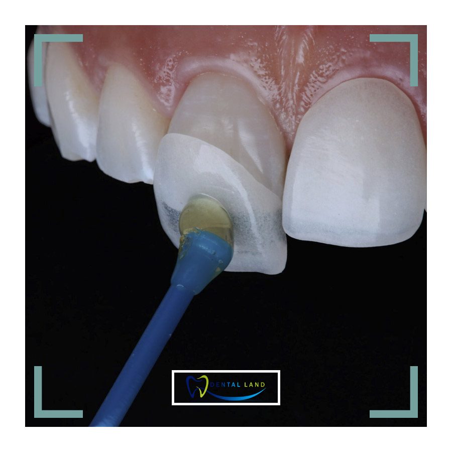 A tooth with a dental tool applying dental veneers